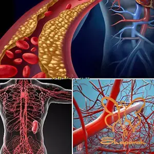 نکروبیوز لیپویدیکا چطور اتفاق می افتد فرآیند تغییر بافت پوست نکروبیوز لیپویدیکا چطور اتفاق می افتد فرآیند تغییر بافت پوست
