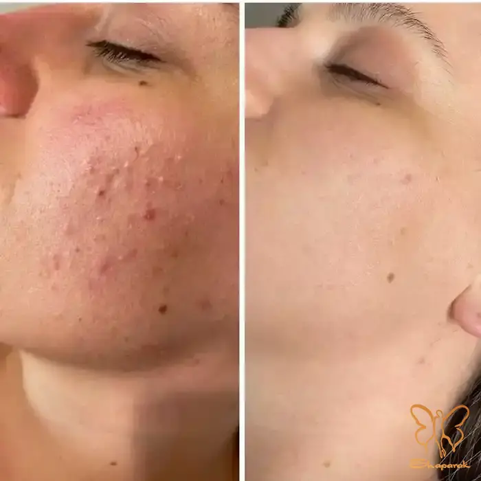  کلینیک تخصصی لیزر موهای زائد شاپرک طلایی مشهد