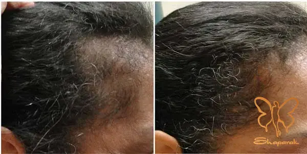 مزوتراپی سر و صورت در مشهد مزوتراپی سر و صورت در مشهد