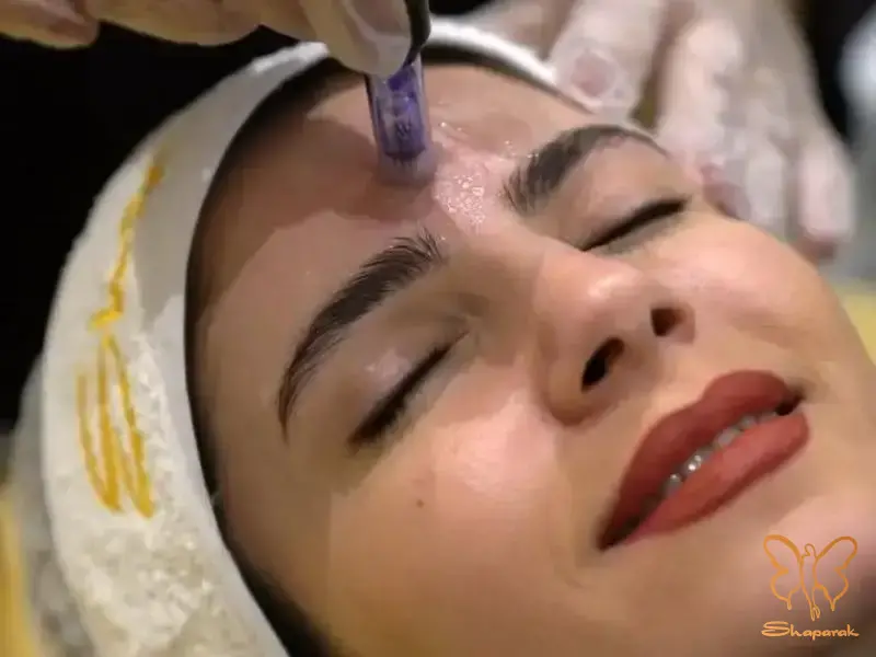 دلایل اثربخشی بالای درمان ترکیبی پیلینگ و میکرونیدلینگ در مشهد