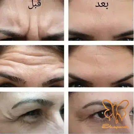 پدیده کوبنر Koebner پدیده کوبنر Koebner