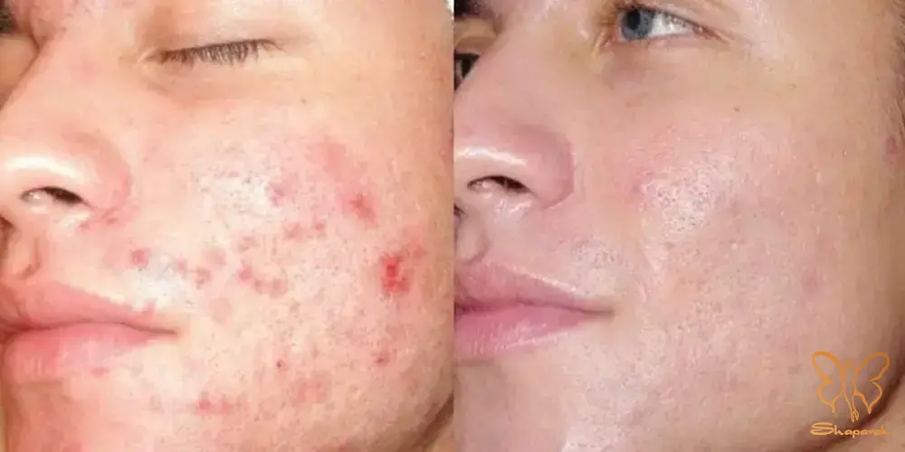  تحریک کلاژن و الاستین سازی