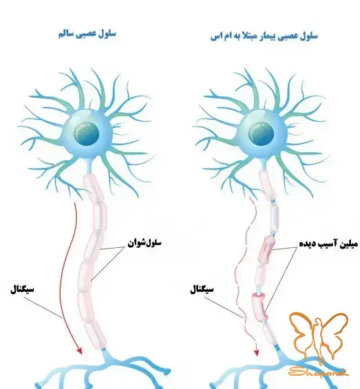 آیا ام اس یک بیماری ژنتیکی است یا خودایمنی آیا ام اس یک بیماری ژنتیکی است یا خودایمنی