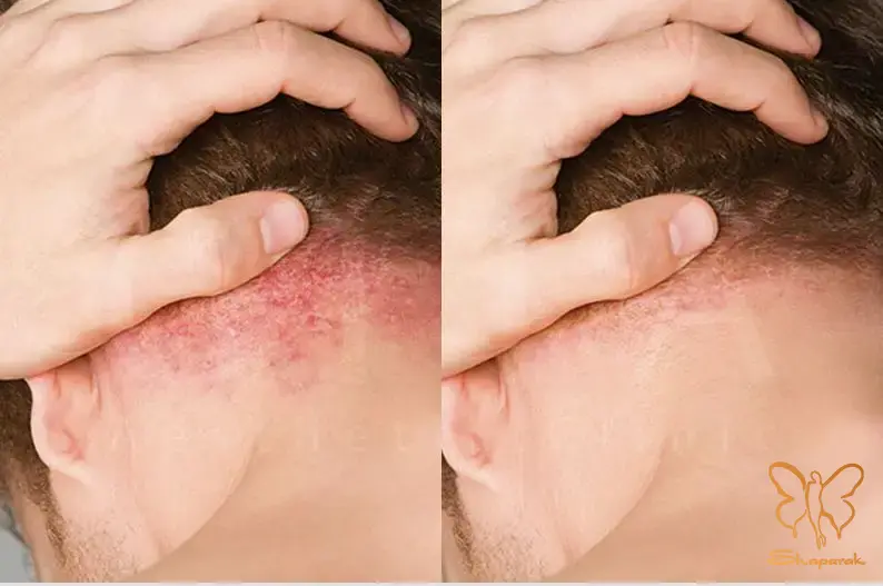 یک پاسخ غیرعادی و گاه دردسرساز در پوست برخی بیماران است