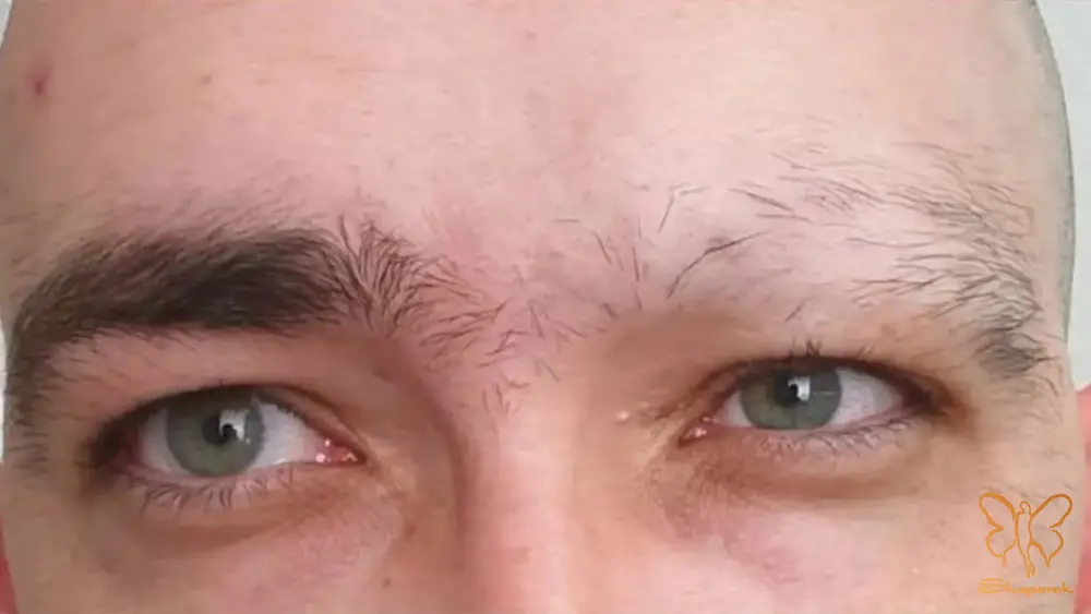 پدیده کوبنر Koebner Phenomenon پدیده کوبنر Koebner Phenomenon