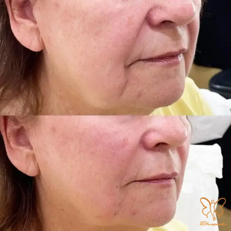 جوانسازی پوست جوانسازی پوست