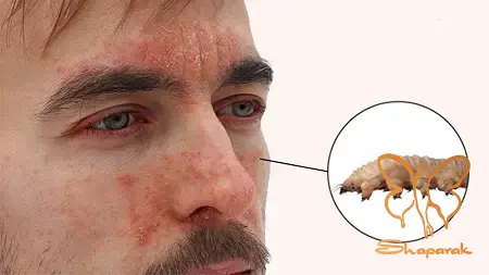 در فاز التهابی و فعال