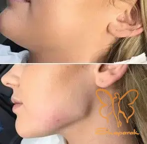 مادلینگ صورت با تزریق ژل زاویه فک مشهد