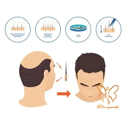 گام های کلیدی فرآیند از مشاوره تا کاشت مو نهایی