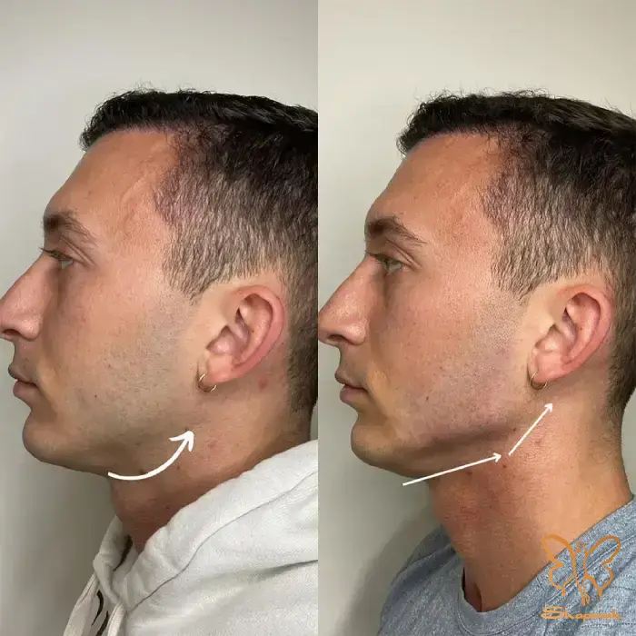 تفاوت تزریق ژل برای مادلینگ صورت در آقایان و خانم ها