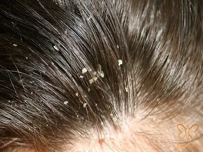 تشخیص وضعیت پوست سر تشخیص وضعیت پوست سر