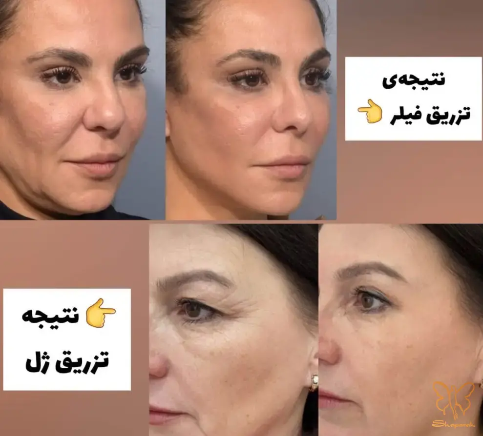 تزریق ژل فیلر و چربی در مشهد تزریق ژل فیلر و چربی در مشهد