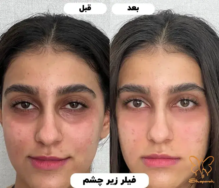 فیلر زیر چشم مشهد