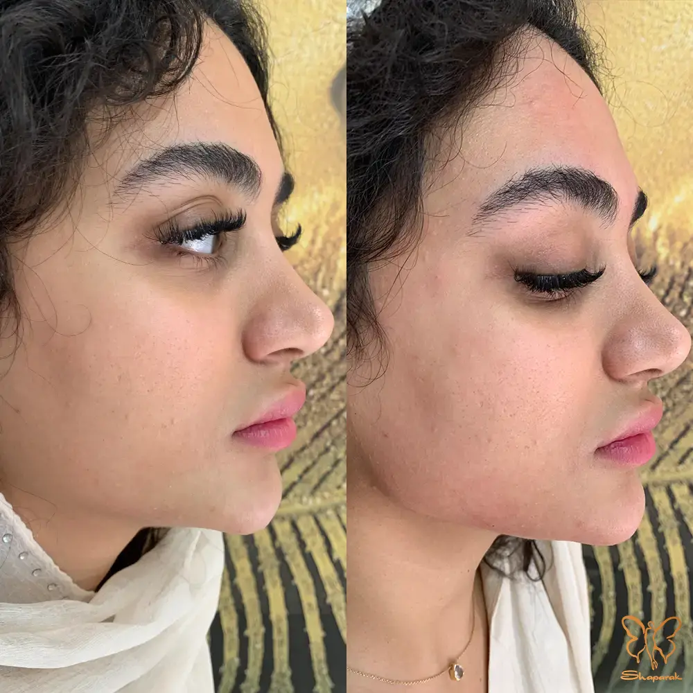 خاستگاه و ویژگی های ژل رئوفیل پلاس در چیست