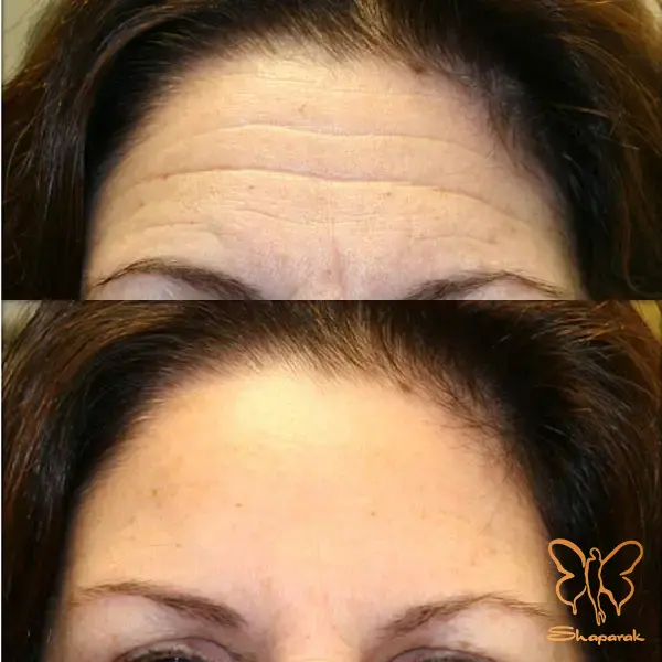 تزریق بوتاکس مشهد تزریق بوتاکس مشهد