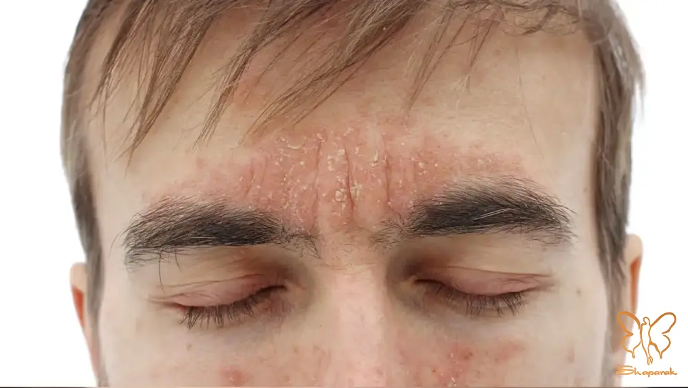 درماتیت سبورئیک Seborrheic Dermatitis درماتیت سبورئیک Seborrheic Dermatitis