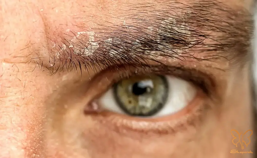 عفونت های قارچی پوست سر Tinea Capitis عفونت های قارچی پوست سر Tinea Capitis