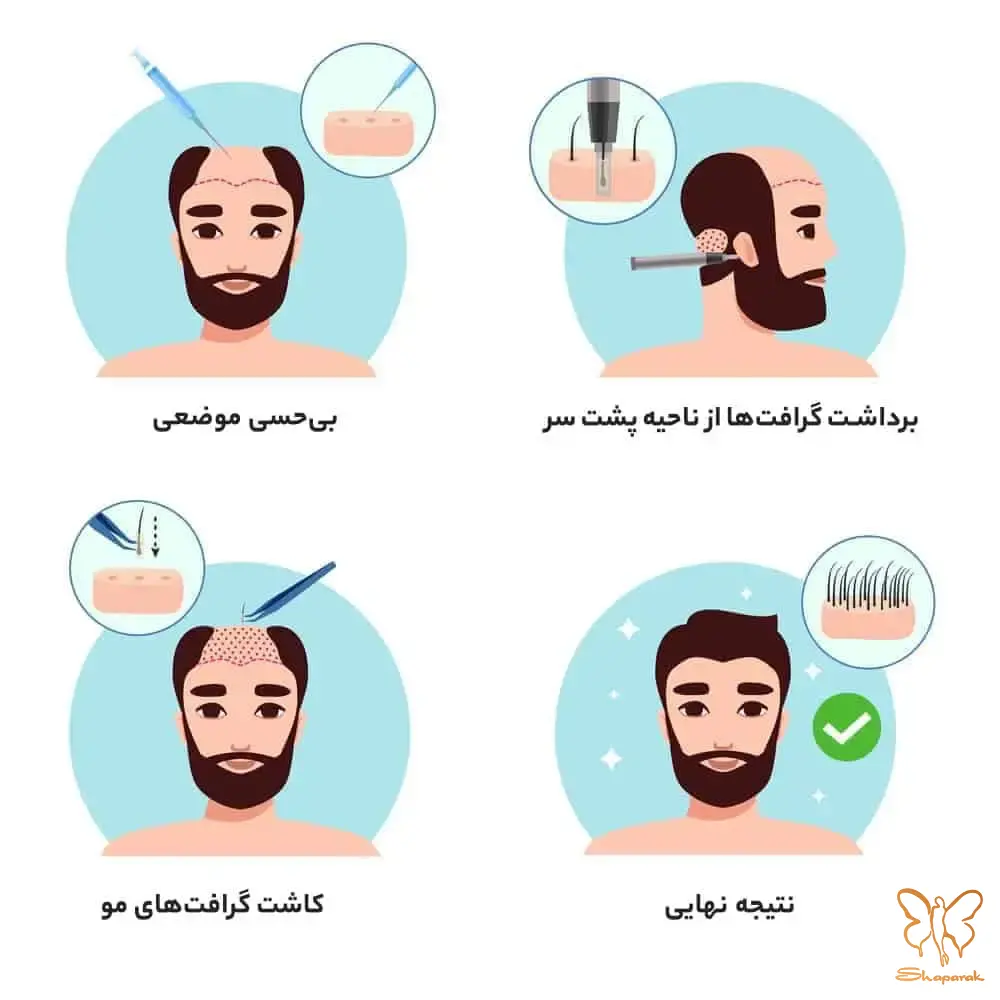  درمان ریزش مو