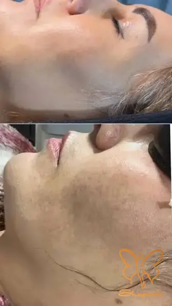 فوتونا فرکشنال صورت مشهد فوتونا فرکشنال صورت مشهد