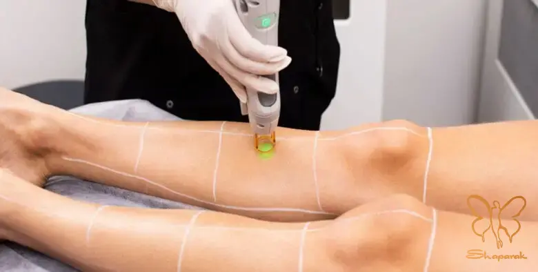 لیزر موهای زائد در کلینیک شاپرک طلایی مشهد لیزر موهای زائد در کلینیک شاپرک طلایی مشهد