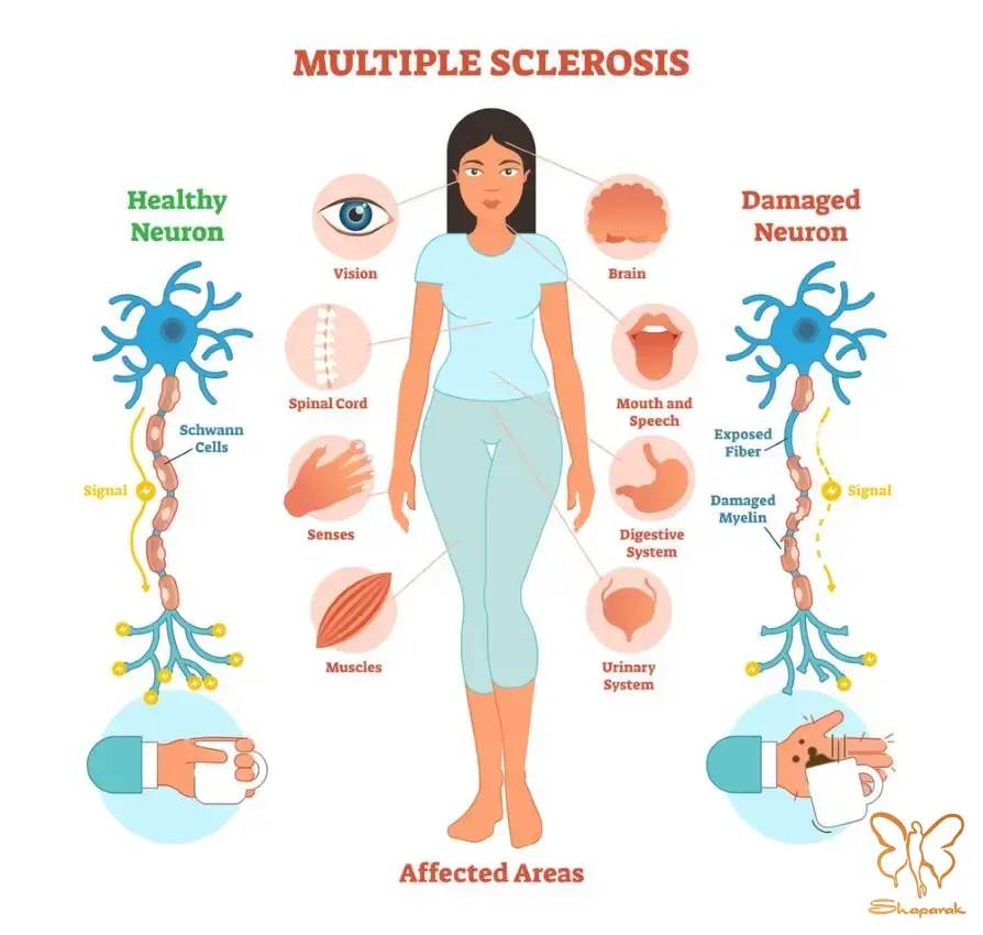 علائم شایع بیماری ام اس چیست علائم شایع بیماری ام اس چیست