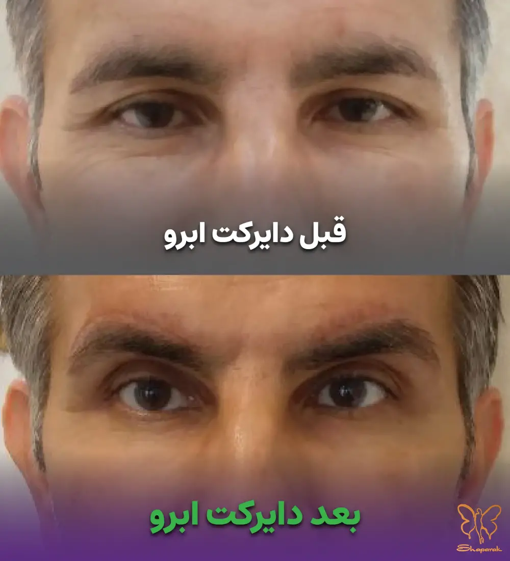 دایرکت ابرو در مشهد راهکاری هوشمندانه برای افزایش فاصله چشم و ابرو