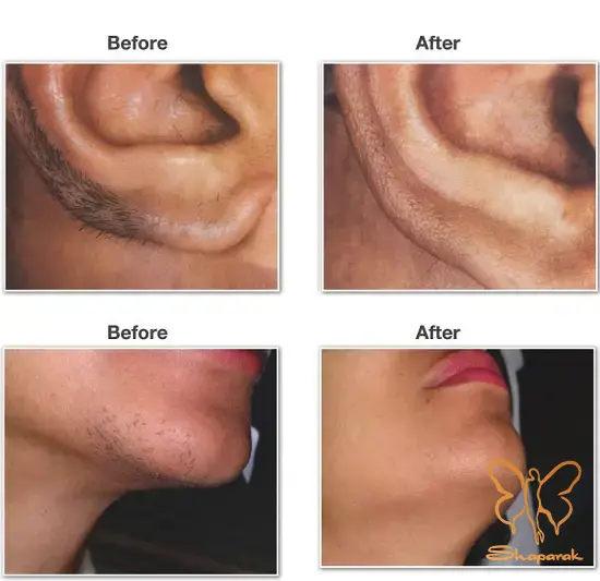 بررسی تفاوت لیزر موهای زائد برای زنان و مردان در کلینیک شاپرک مشهد بررسی تفاوت لیزر موهای زائد برای زنان و مردان در کلینیک شاپرک مشهد