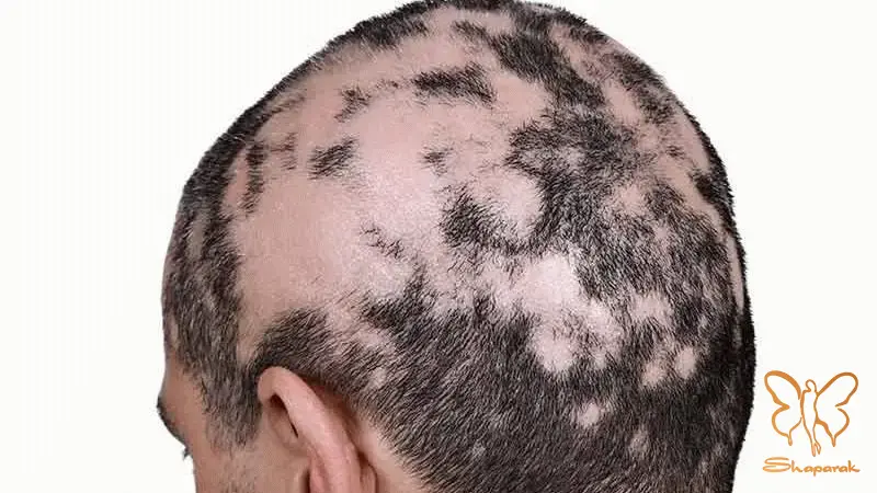 کلینیک تخصصی پوست و مو شاپرک طلایی مشهد کلینیک تخصصی پوست و مو شاپرک طلایی مشهد