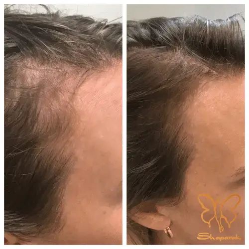  کلینیک تخصصی لیزر موهای زائد شاپرک طلایی مشهد