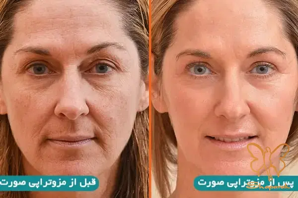 پوستی جوان تر و شاداب تر با مزو لیفت و جوانساز بایواستتیکس مشهد