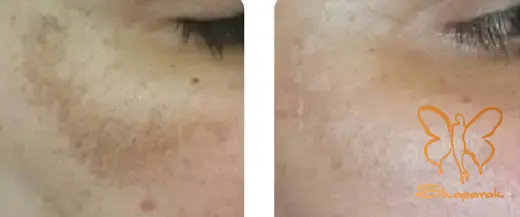 مکانیسم اثر مزو و فوتونا بر ملانین سازی پوست مکانیسم اثر مزو و فوتونا بر ملانین سازی پوست