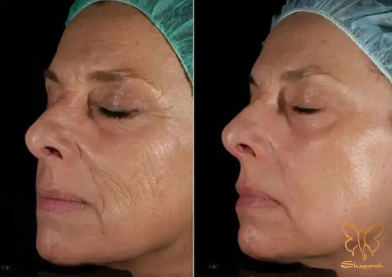 تفاوت مزو بایواستتیکس با مزوتراپی معمولی در کلینیک شاپرک مشهد تفاوت مزو بایواستتیکس با مزوتراپی معمولی در کلینیک شاپرک مشهد