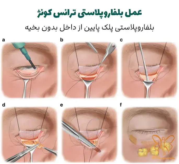 بلفاروپلاستی ترانس کونژ در مشهد