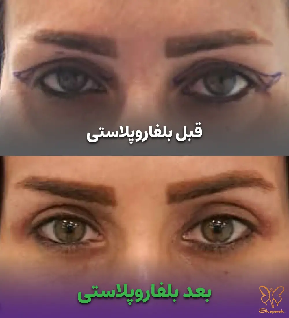 بلفاروپلاستی به روش کلاسیک دقت در پنهانسازی خط برش