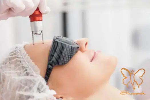 موارد منع استفاده یا احتیاط شدید از لیزر فوتونا برای پوست اگزمایی و حساس موارد منع استفاده یا احتیاط شدید از لیزر فوتونا برای پوست اگزمایی و حساس