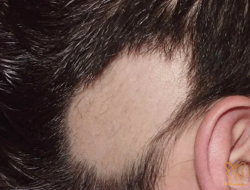 آیا LPP و FFA درمان قطعی دارند آیا LPP و FFA درمان قطعی دارند