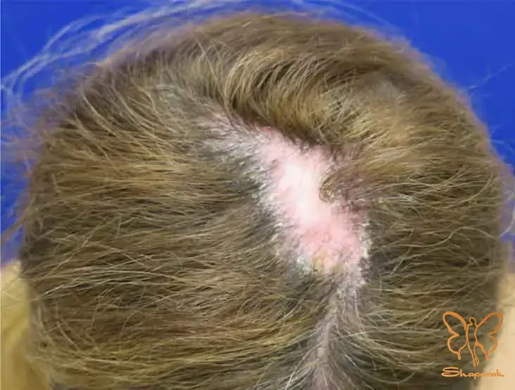 آلوپسی فیبروزان فرونتال FFA نوعی خاص از LPP آلوپسی فیبروزان فرونتال FFA نوعی خاص از LPP