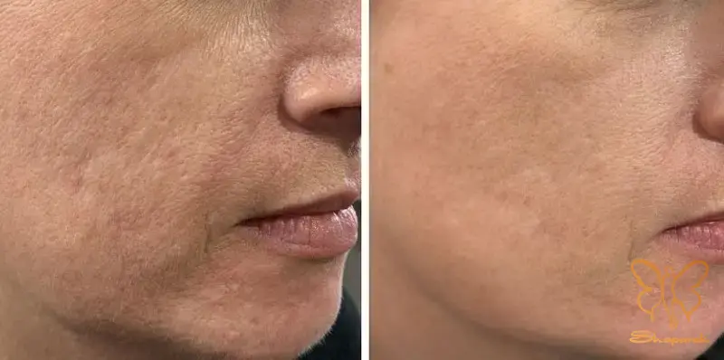  تحریک کلاژن و الاستین سازی