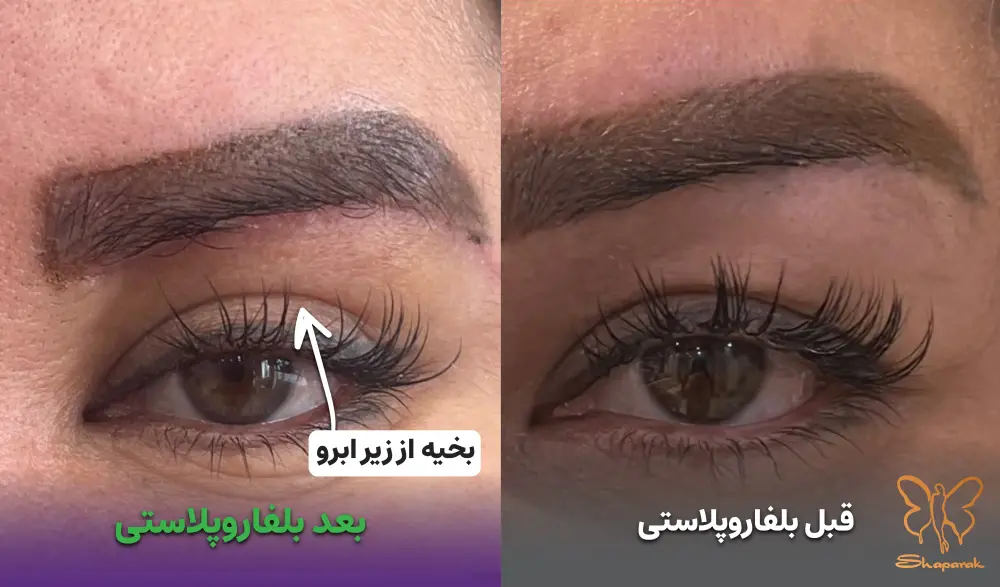 بلفاروپلاستی زیر ابرو راه حلی نوین برای پف و چربی شدید