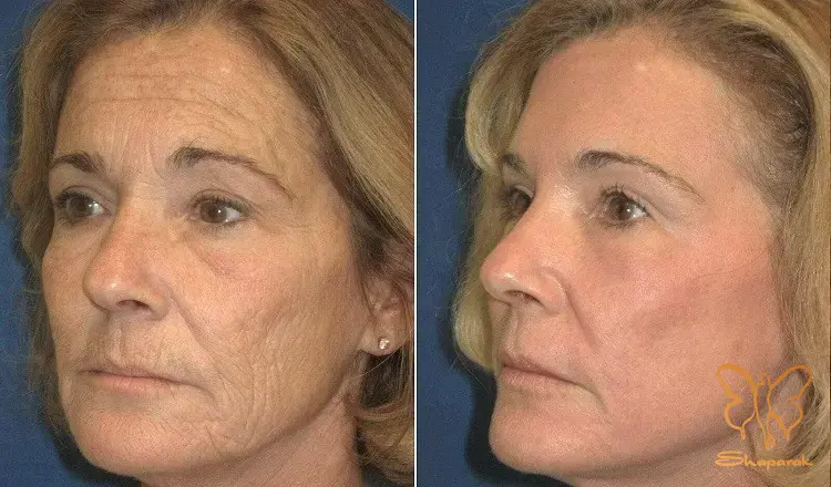 لیفت بدون جراحی و خونریزی با دستگاه فوتونا فرکشنال لیفت بدون جراحی و خونریزی با دستگاه فوتونا فرکشنال