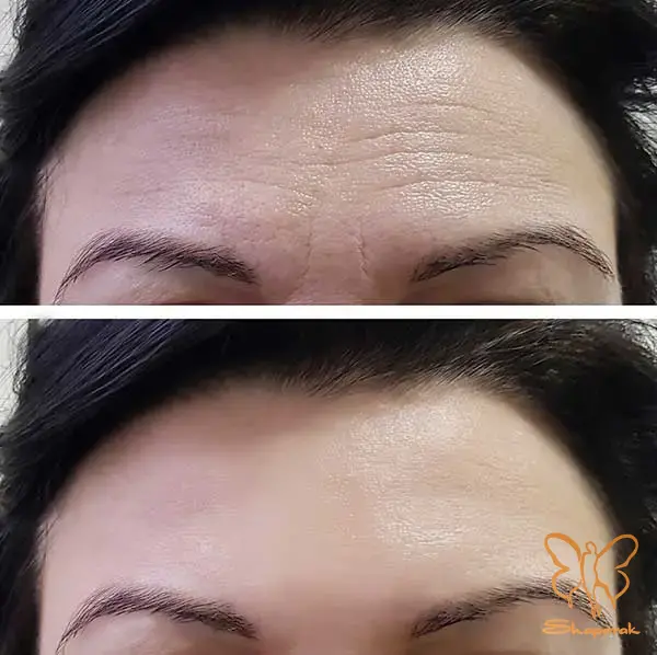 جوانسازی پوست 