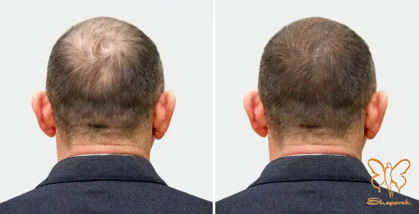 درمان پلاسمای غنی از پلاکت درمان پلاسمای غنی از پلاکت