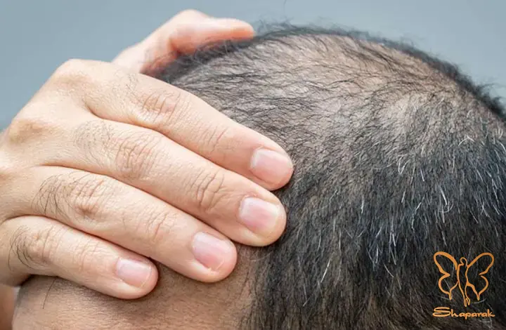 خدمات زیبایی کاملا ممنوع یا بسیار پر خطر در کلینیک شاپرک طلایی خدمات زیبایی کاملا ممنوع یا بسیار پر خطر در کلینیک شاپرک طلایی