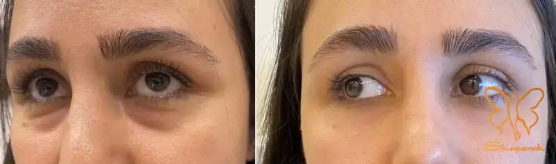 زیبایی چشم ها با مزوژل جالپرو یانگ آی مشهد