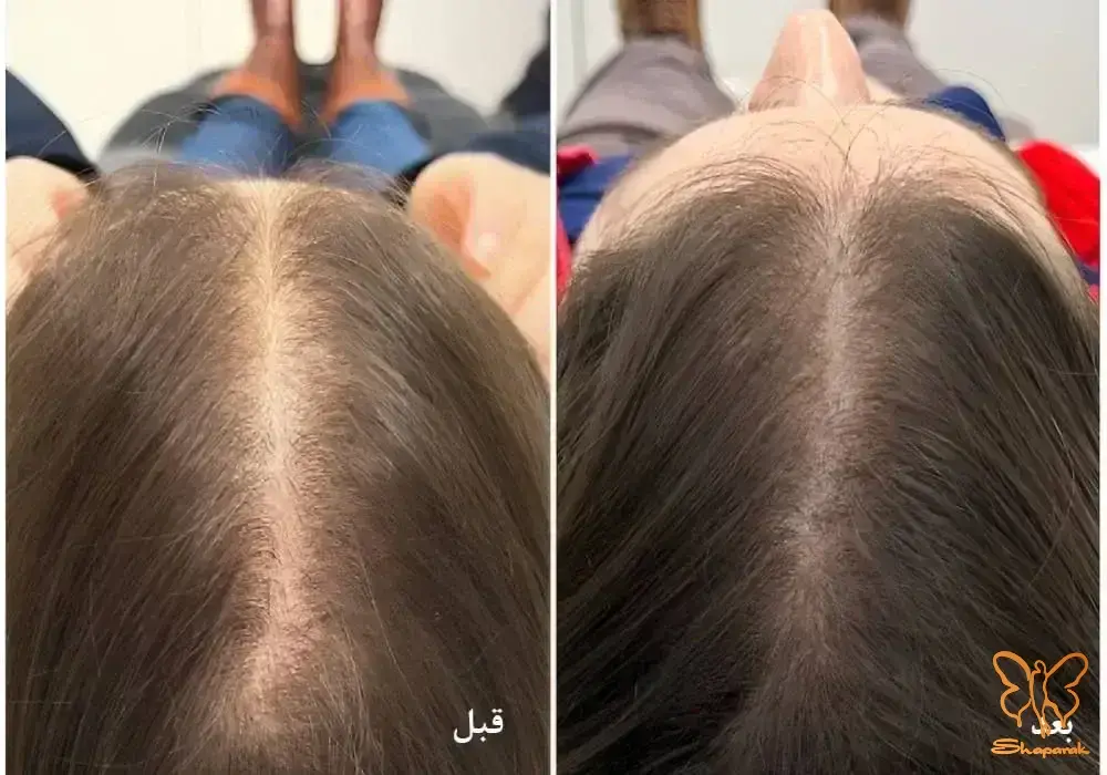 فوتونا میکرودرلینگ سر مشهد جدیدترین درمان ریزش مو بدون درد