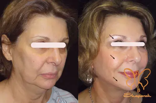 تاریخچه تزریق چربی از بازسازی تا زیباسازی چهره و بدن&nbsp;