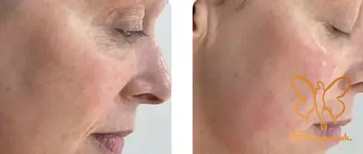 درخشش و شادابی آنی پوست با فوتونا فرکشنال و مزو آبرسان درخشش و شادابی آنی پوست با فوتونا فرکشنال و مزو آبرسان