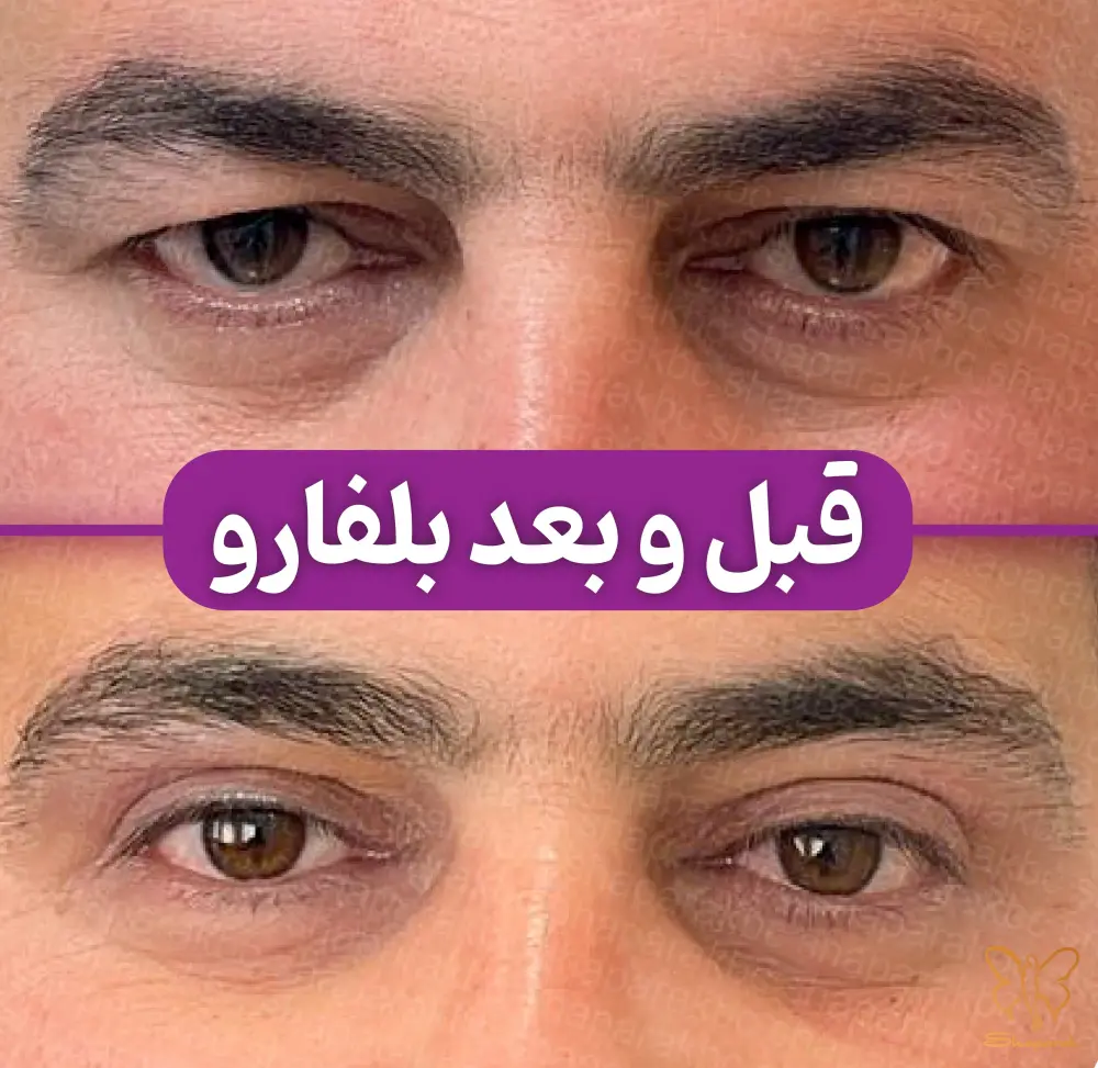 جراحی همزمان پلک در مشهد یا همان بلفارو پلاستی