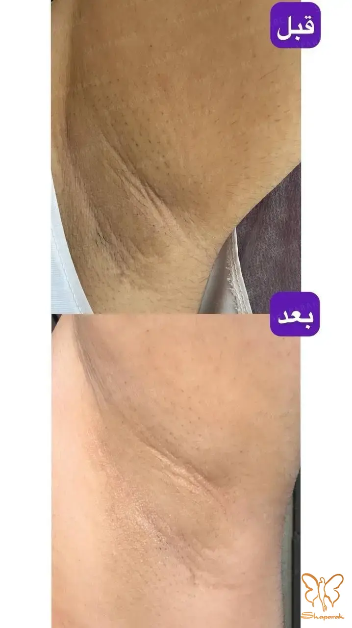 جوانسازی پوست زیر بغل
