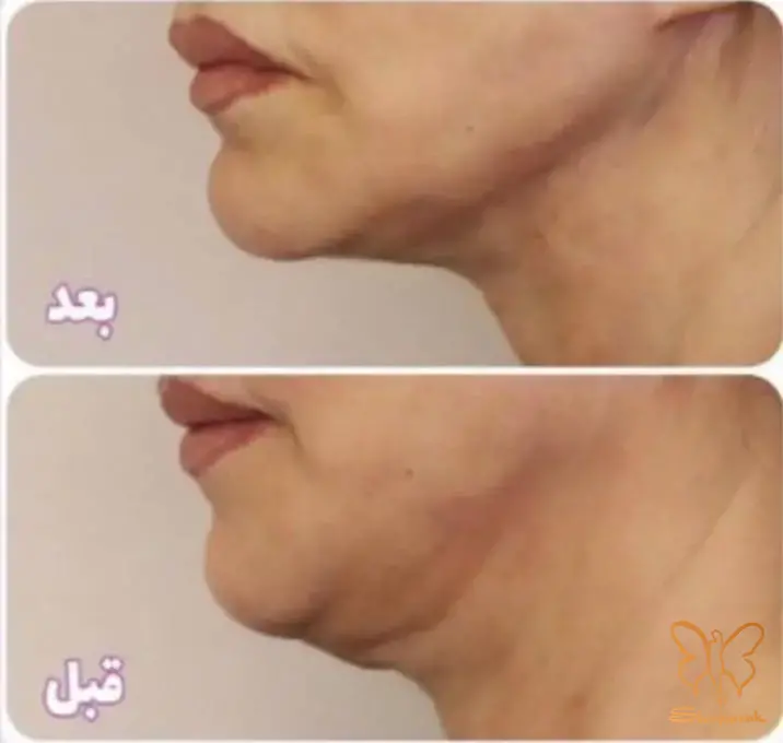 از بین بردن چربی غبغب